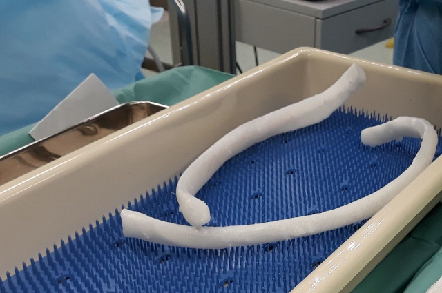 Two 3D printed ribs laid on the tray after sterilization process in the hospital.